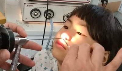 Из носа вьетнамской девочки извлекли большого паразита