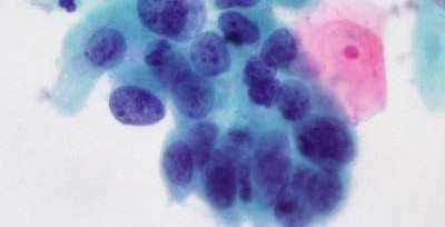 Ученые заставили макрофаги активно уничтожать раковые клетки