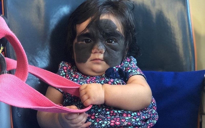 КРАСНОДАР. Девочка с «маской Бэтмена» прилетела из США в Краснодар на лечение