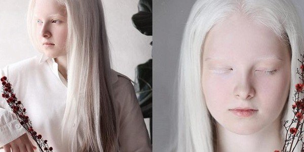 ЧЕЧНЯ. Девочка из Чечни восхищает своей необычной красотой, однако альбинизм — не единственное, что отличает её от других