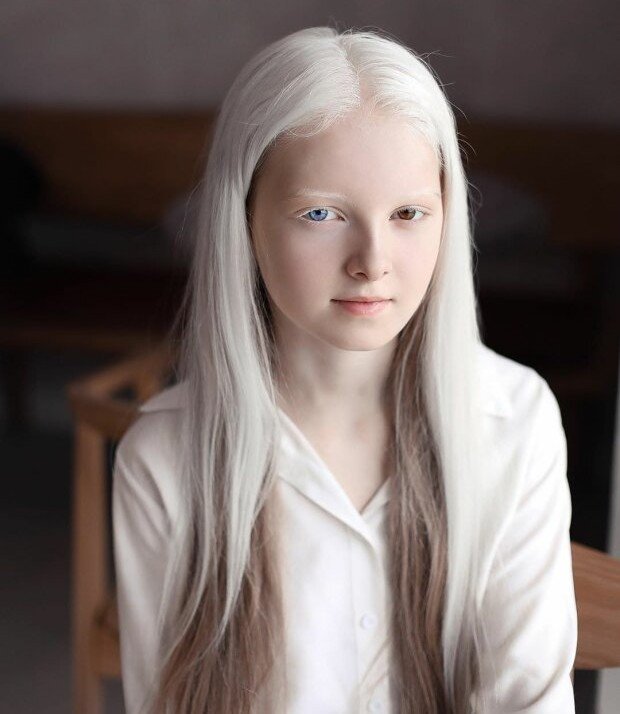 ЧЕЧНЯ. Девочка-альбинос из Чечни поразила мир двойной мутацией: эти глаза словно ангельский свет