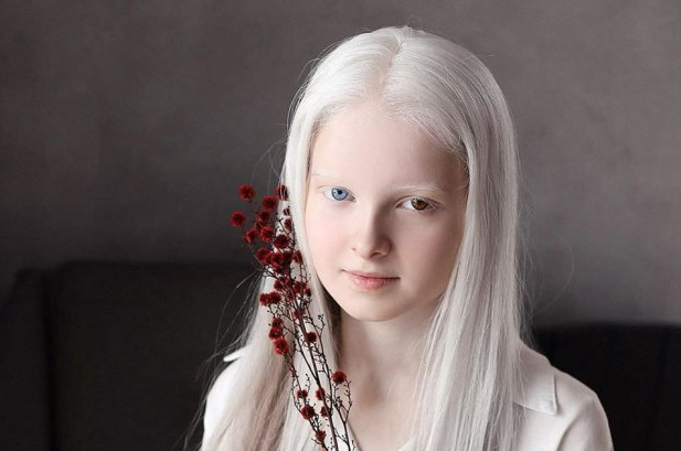ЧЕЧНЯ. "Чеченский альбинос" Амина Эпендиева - девочка с завораживающей красотой